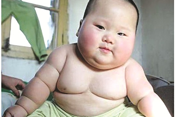 Hội chứng Prader-Willi - Hình ảnh minh họa